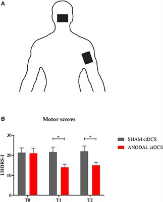 Cerebellar Direct Current Stimulation (ctDCS) in the Treatment of Huntington's Disease: A Pilot Study and a Short Review of the Literature